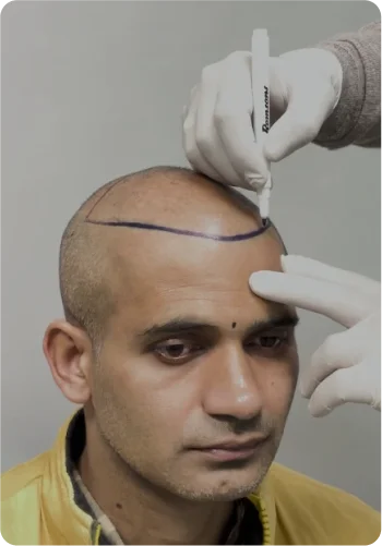 Scarless Hair Transplant Delhi – What Patients Should Know