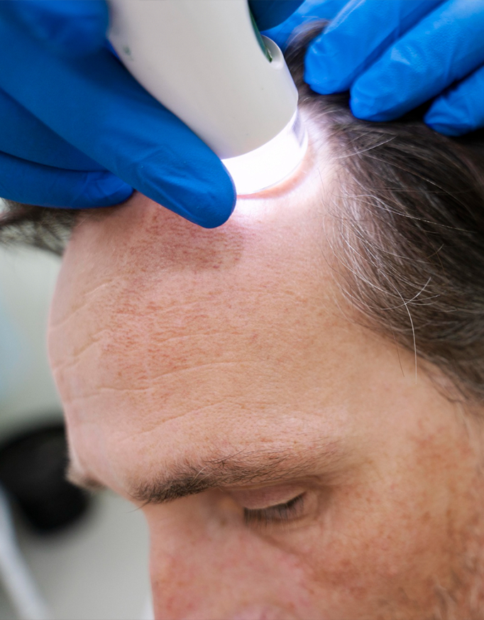 Hair Transplant Techniques and Costs in Delhi