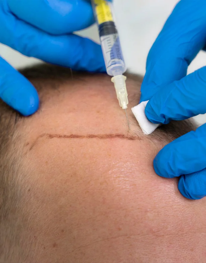 Understanding Affordable Hair Transplant in Delhi