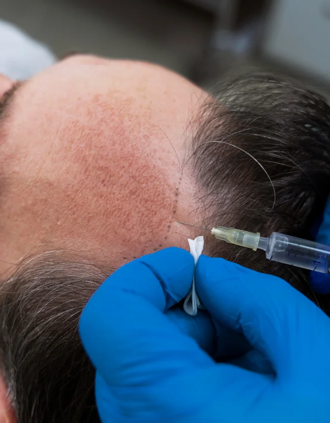 Cheap vs Affordable Hair Transplant in Delhi