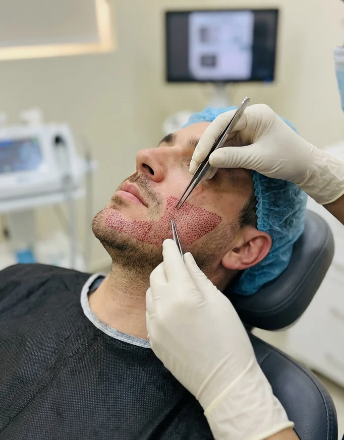 What is a Beard Hair Transplant?
