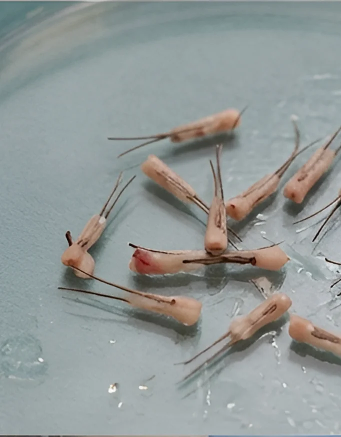 What Is a Graft in Hair Transplant Surgery?