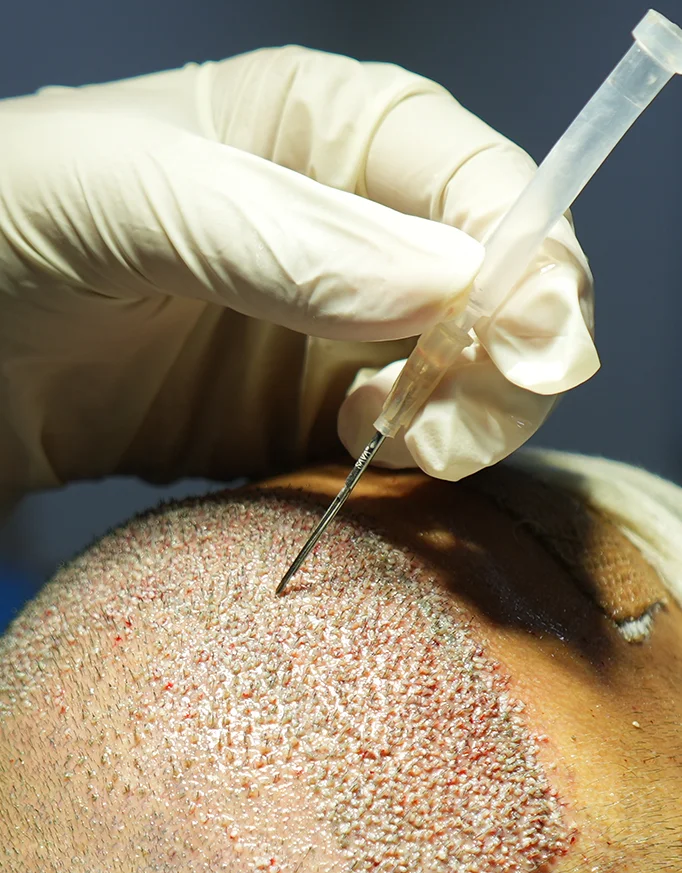 FUE Graft Cost Delhi: Why Technique Matters?