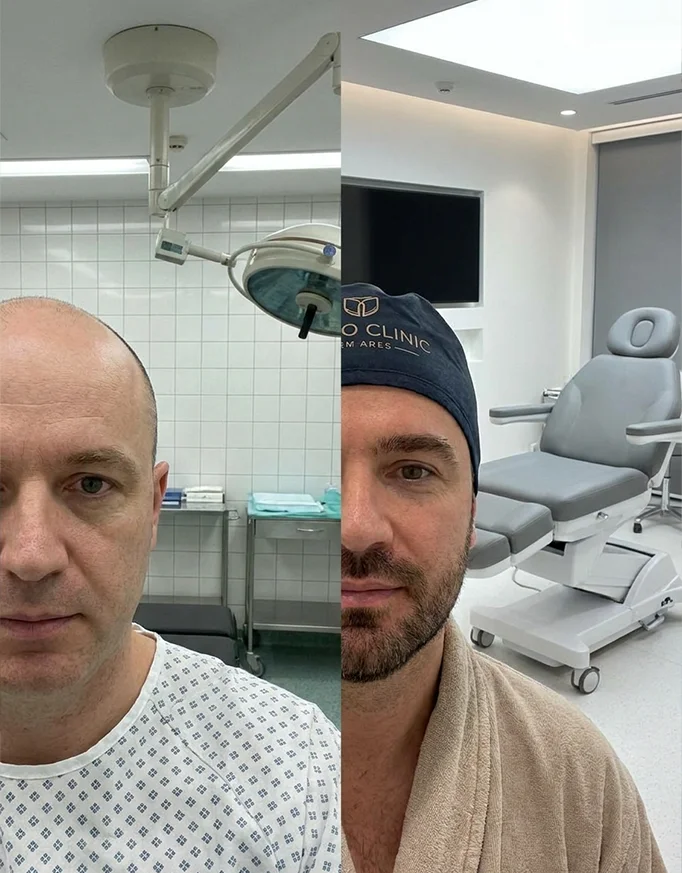 Difference Between Government and Private Hair Transplant in Delhi
