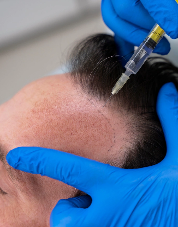 Hair Transplant Cost in Delhi: What Patients Should Know?