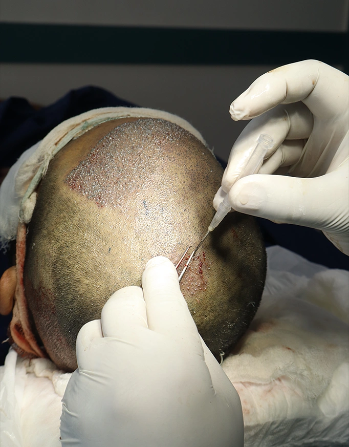 Understanding FUE Hair Transplant in Delhi