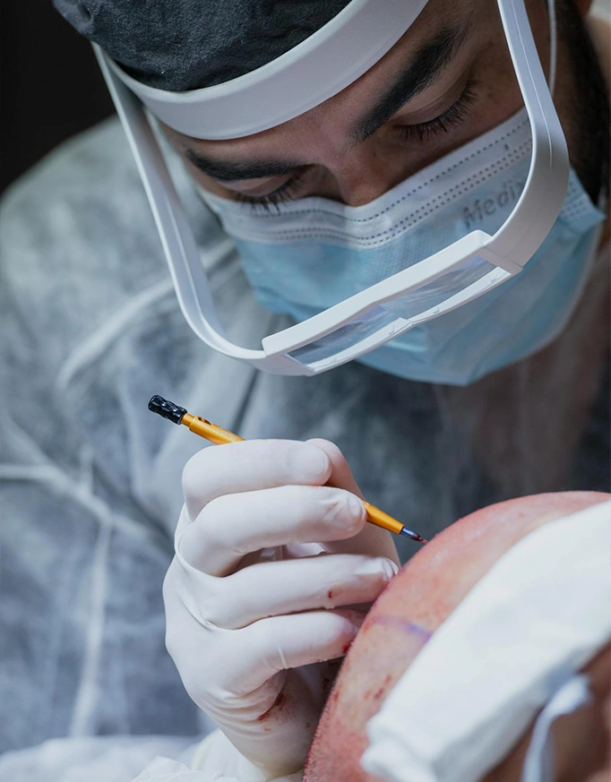 How Many Grafts Do You Need for Hair Transplant?