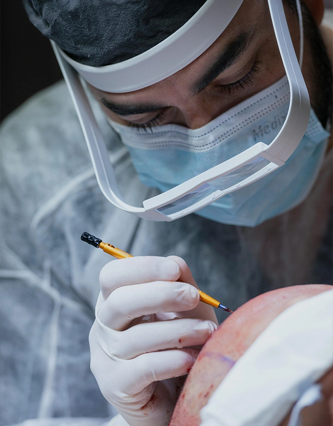 Can the Donor Area Run Out of Grafts?