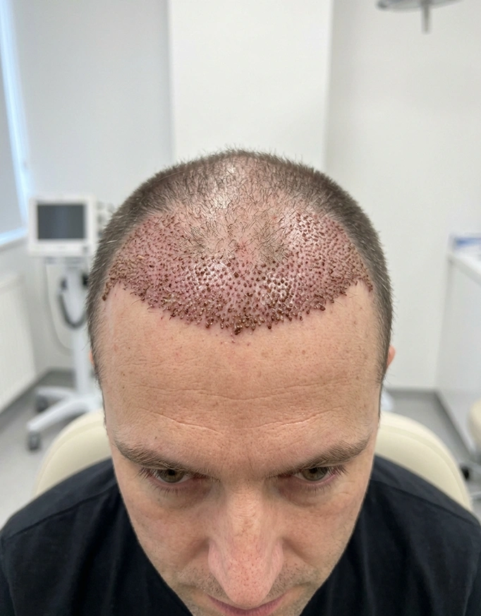 Criteria for Grade 3 Hair Transplant in Delhi