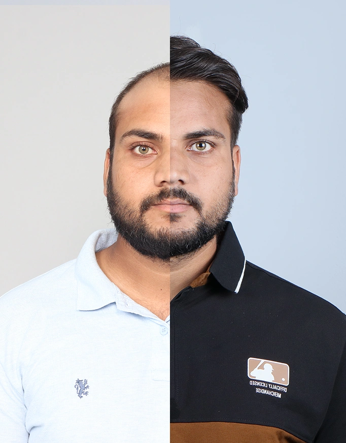 Before After Hair Transplant Delhi: How to Read Results Correctly?