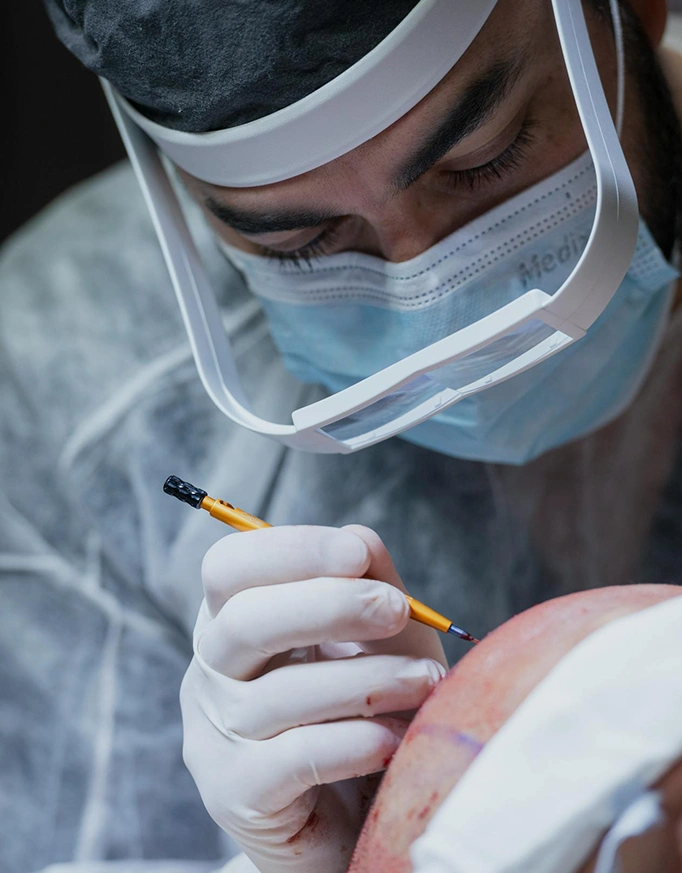 Surgical Planning in Grade 3 Baldness
