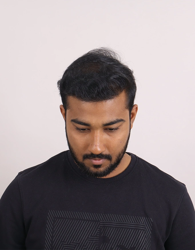 What Makes Hair Transplant Results Look Natural?
