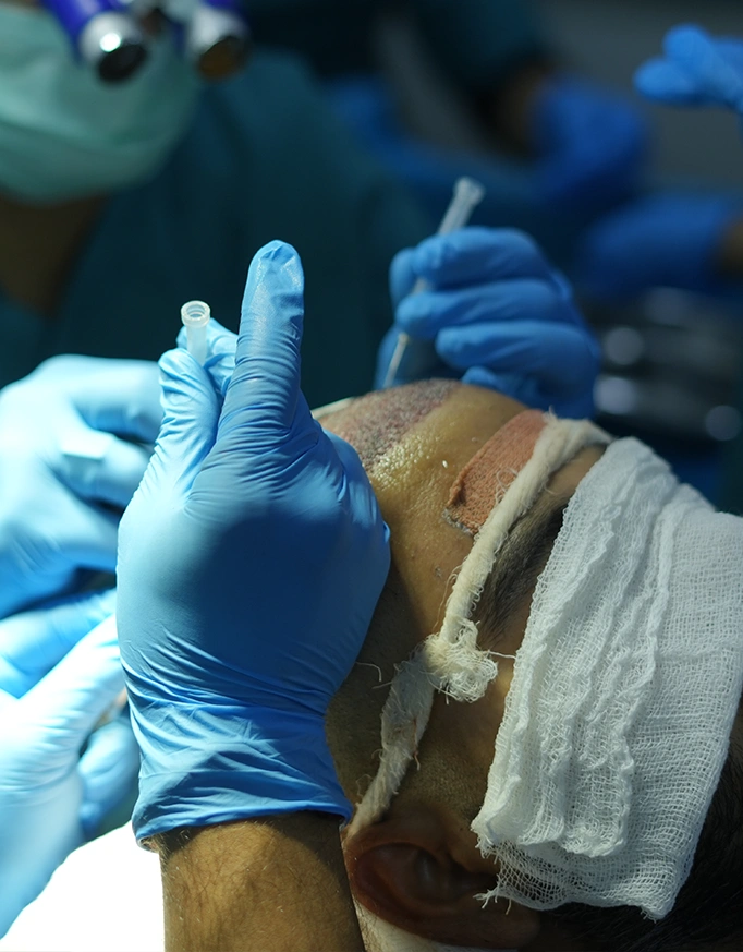 Follicular Unit Extraction Delhi – How the Procedure Works