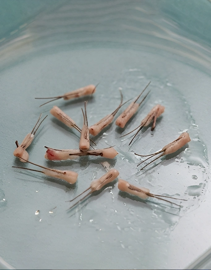 Graft Planning and Allocation in Crown Hair Transplant