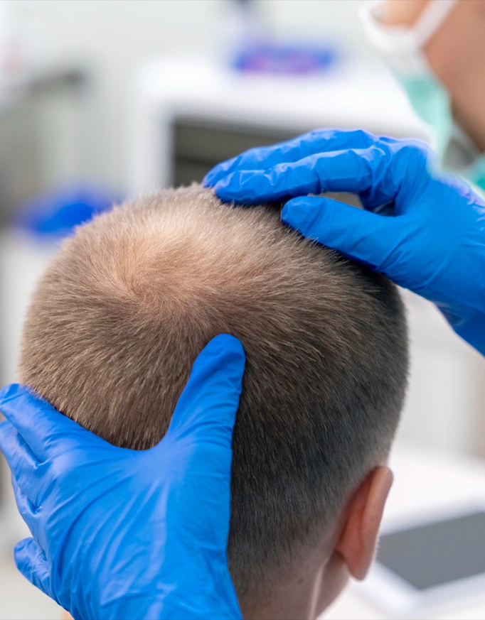 When Is a Crown Hair Transplant Not Recommended?