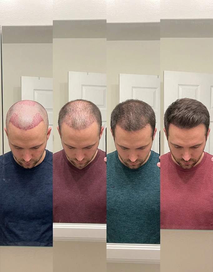 Stages of Hair Transplant Results