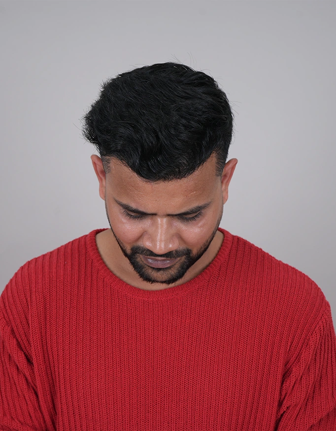 Advantages of FUE Hair Transplant in Delhi