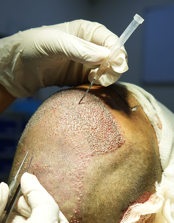 What are the different hair transplant techniques?