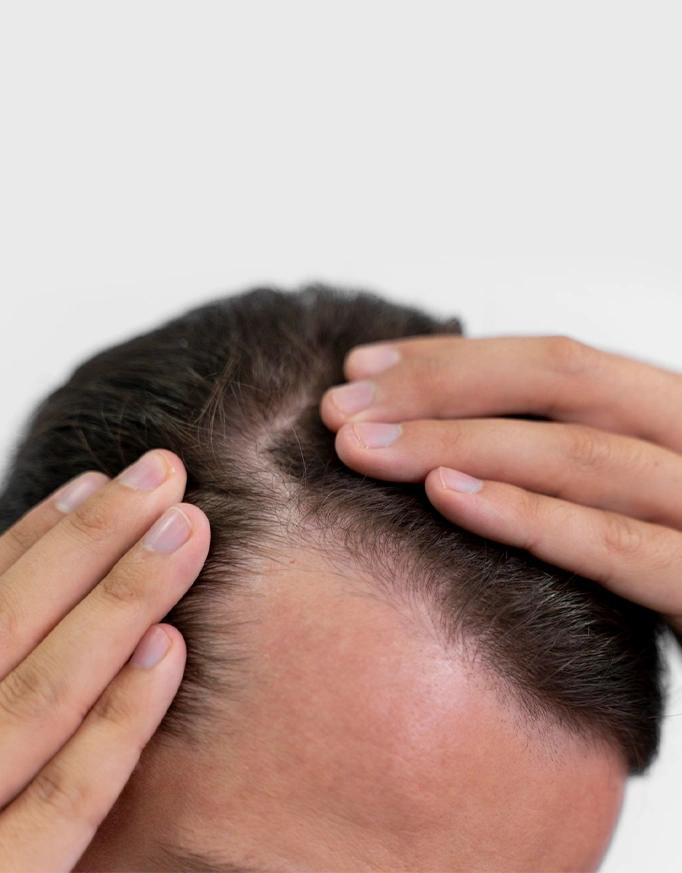 Disadvantages and Considerations of FUE Hair Transplant