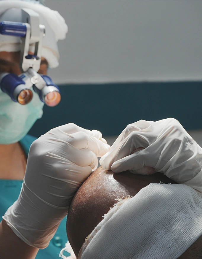 Before & After: Beard Transplant Results Gallery