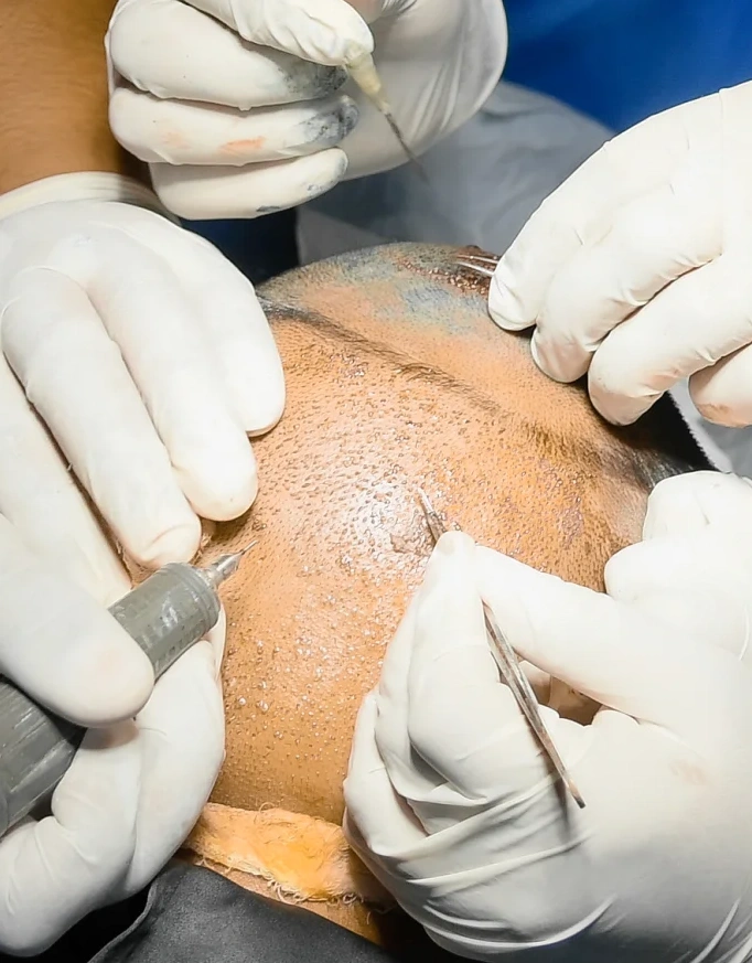 Can Graft Estimates Change Over Time?