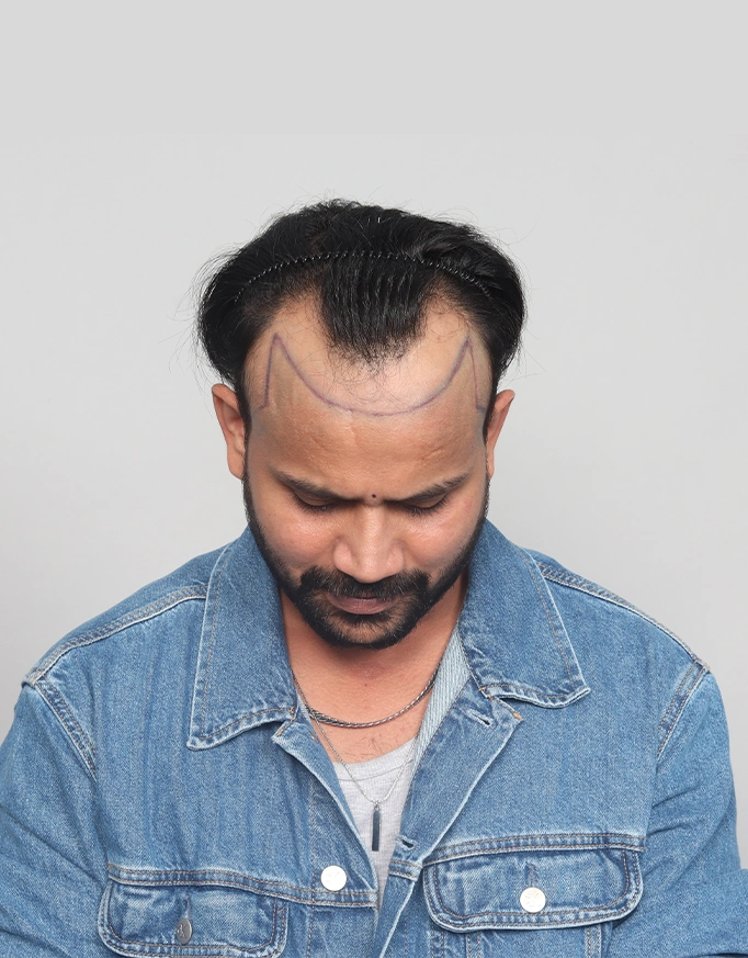 Who is an Ideal Candidate for FUE Hair Transplant?