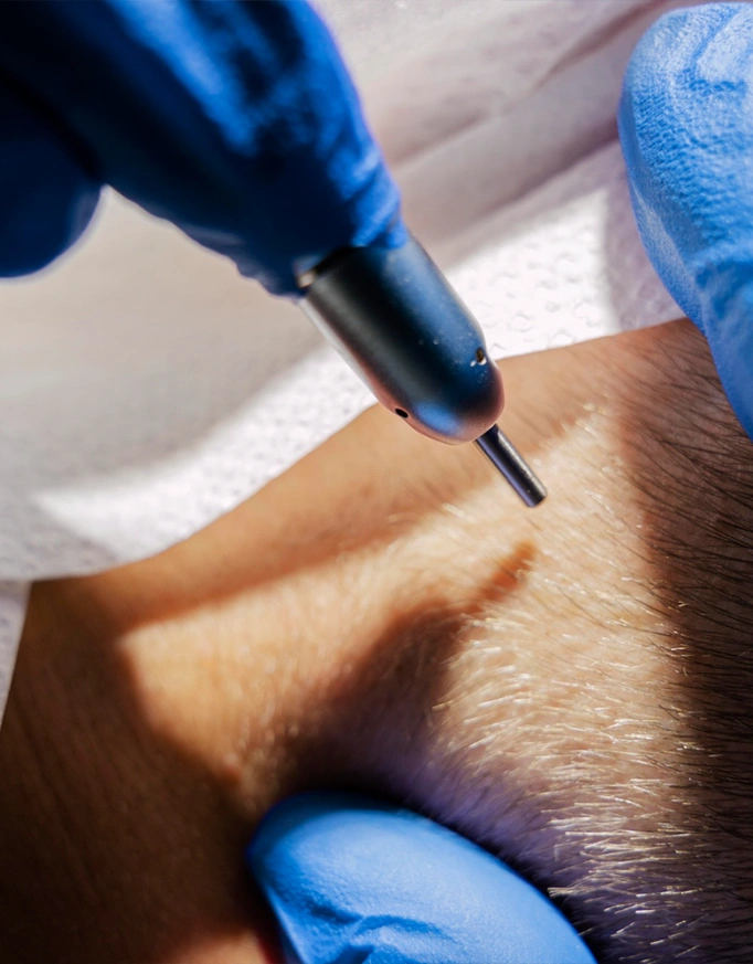 Why Is Donor Hair Important?