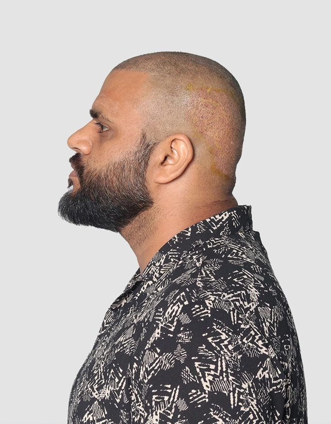 Hair Growth Timeline After the Procedure
