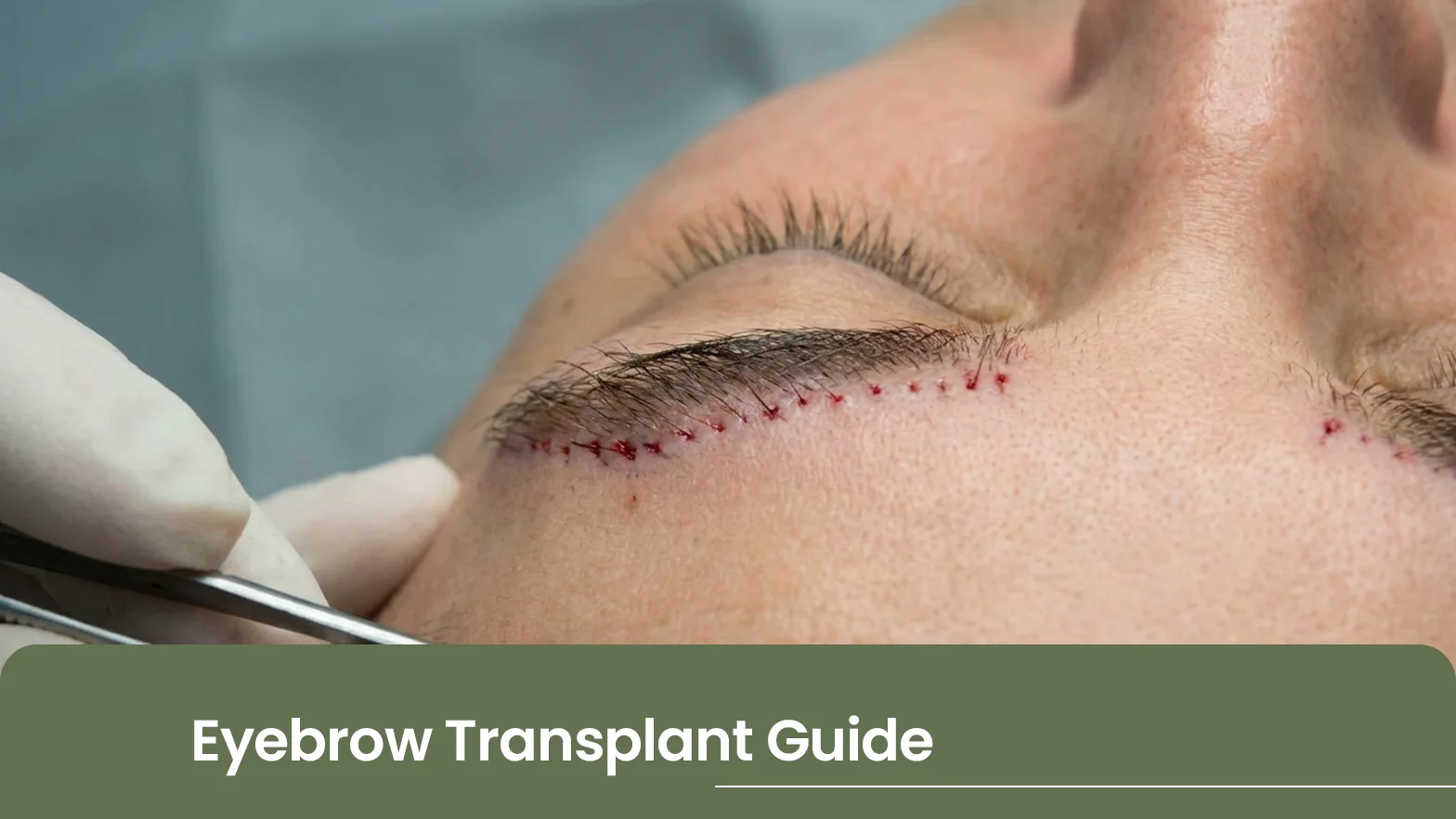 Eyebrow Transplant Guide