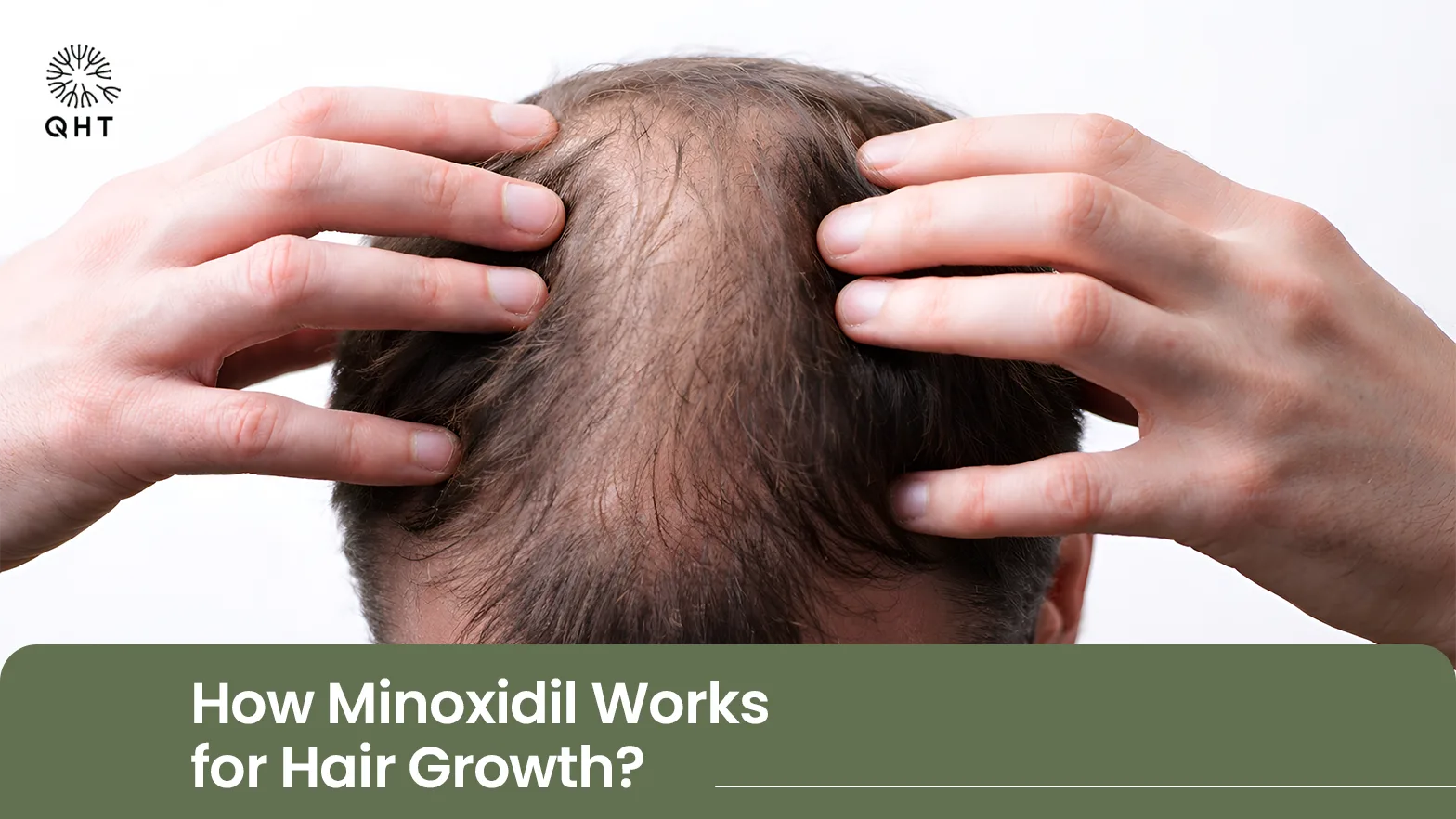 What is Minoxidil, Effect of hair growth , need for hair transplant