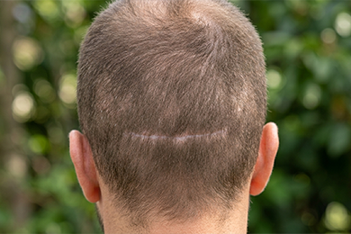 Scar Minimisation Focus