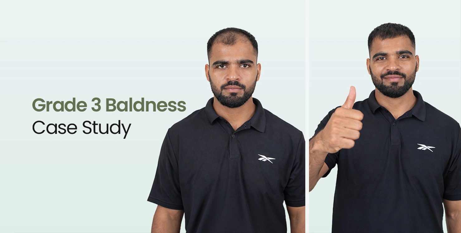 Grade 3 Baldness Case Study