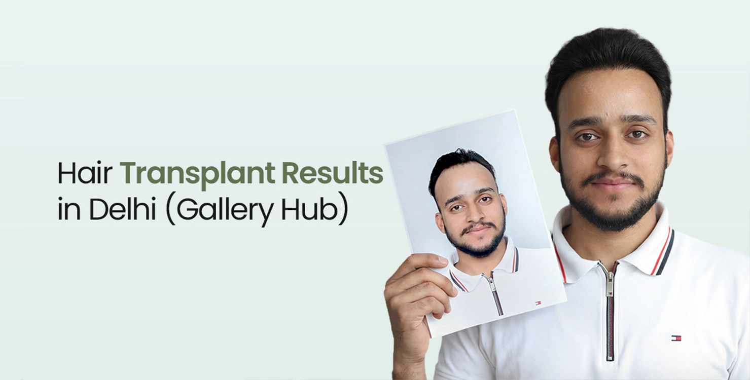 Hair Transplant Results in Delhi