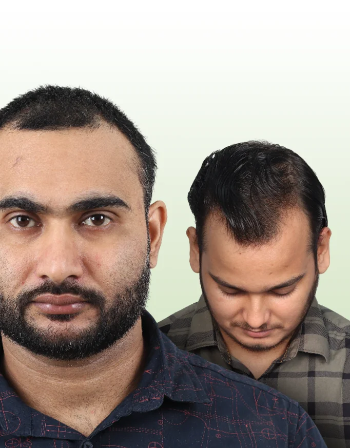 Hairline Design: Why Age Influences Aesthetics