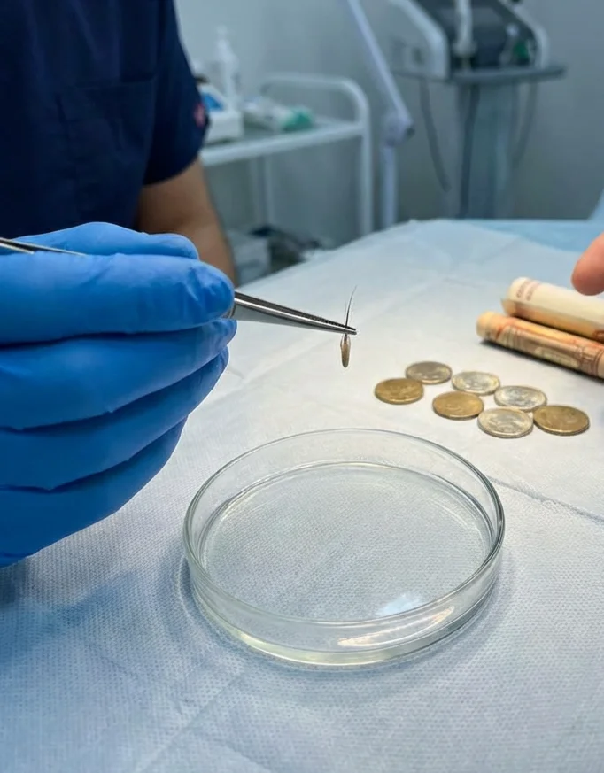 Understanding FUE Graft Cost Delhi Clinics Follow
