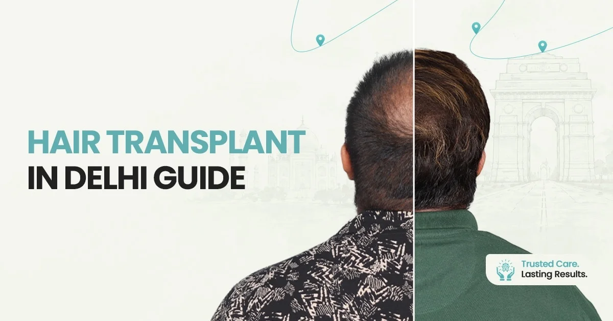 Hair Transplant in Delhi Guide