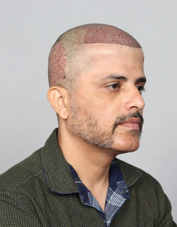 Hair Transplant Cost in India 2026 | Price Breakdown