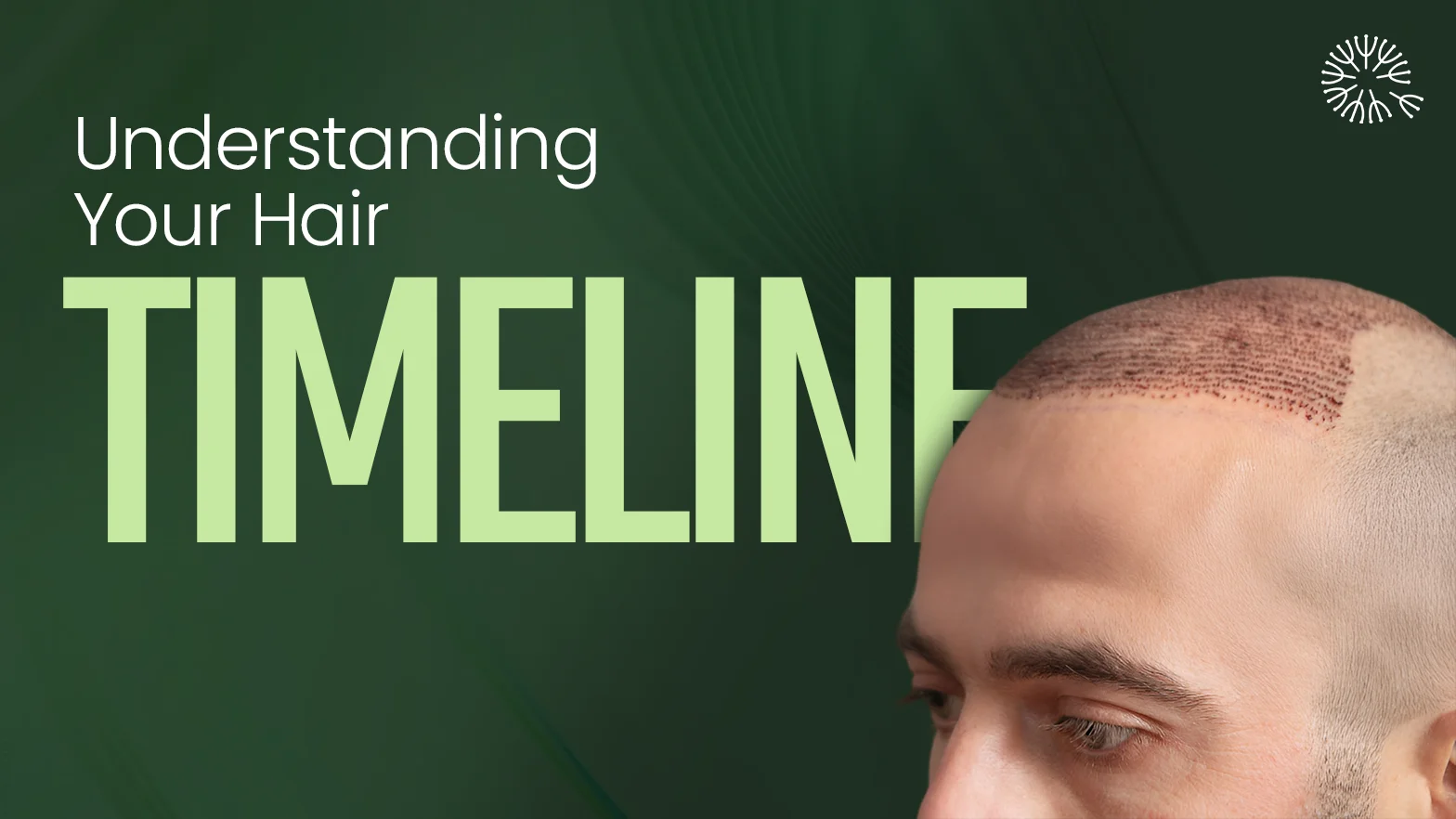 Hair Transplant Results Timeline: What to Expect Month by Month