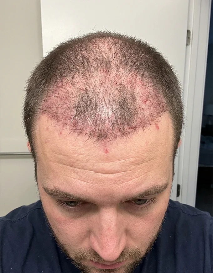 Common Risks & Side Effects of Hair Transplant