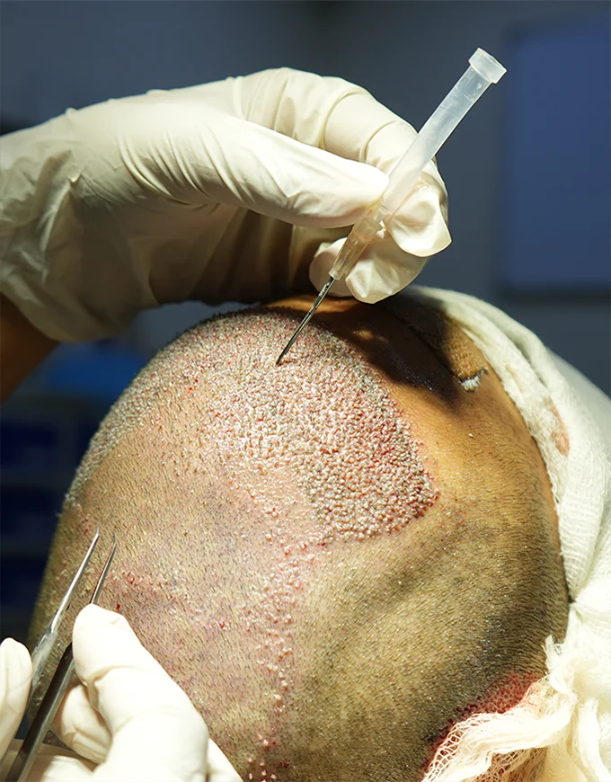 Post-Op Safety: Infection Prevention & Wound Care