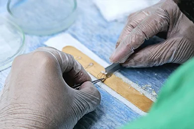 Personalised graft mapping