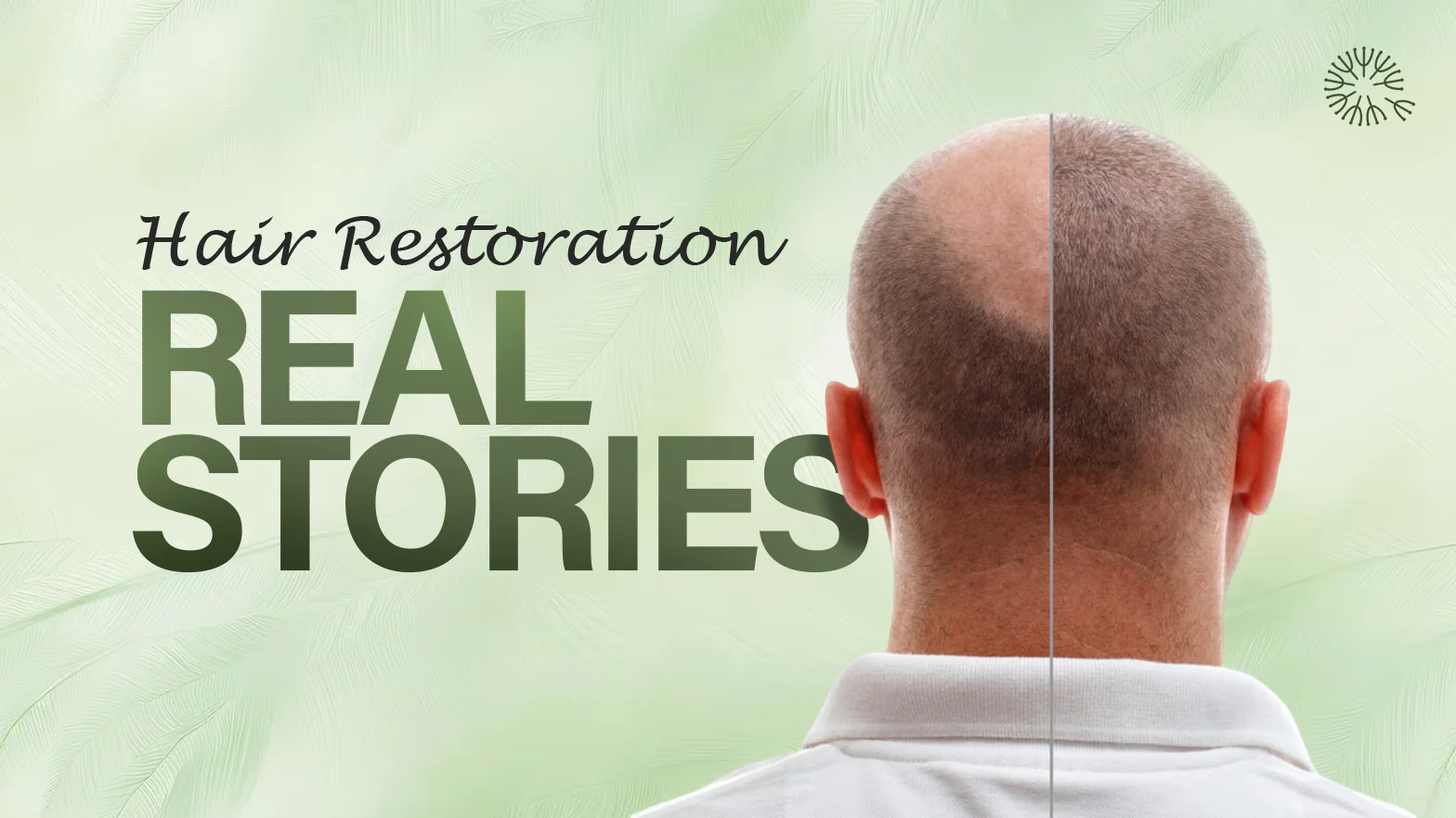 Top 5 Hair Transplant Stories from QHT Clinic