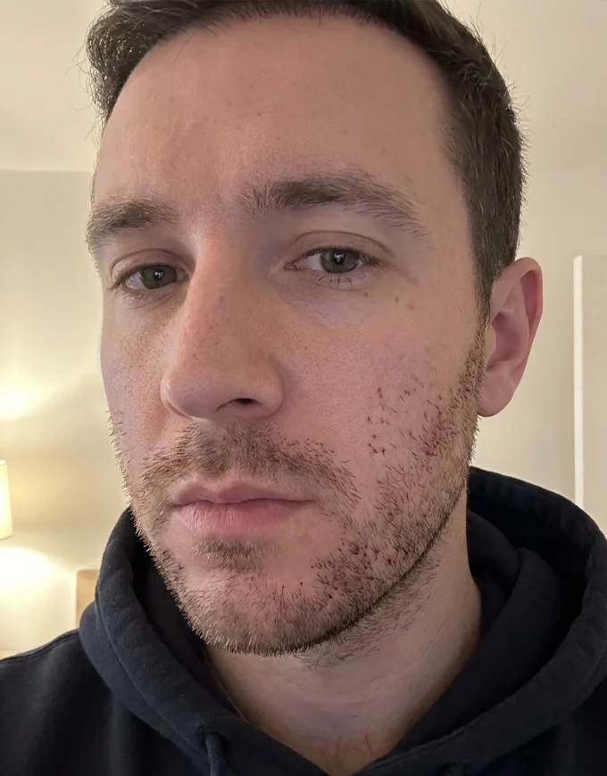 Recovery & Aftercare Timeline for Beard Transplant