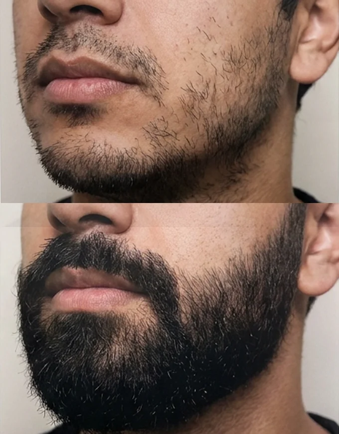 Before & After: Beard Transplant Results Gallery