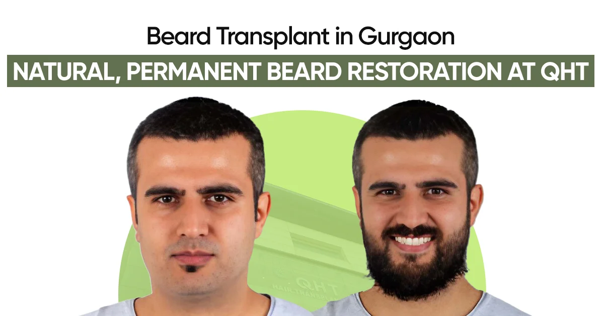 Beard Transplant in Gurgaon