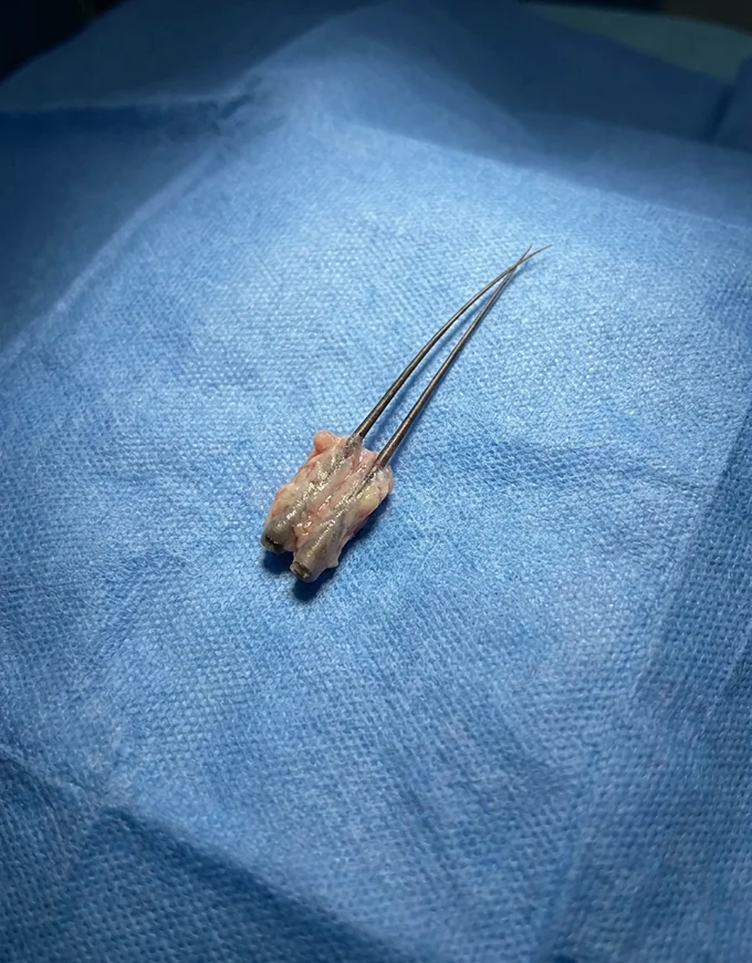 Total FUE Cost Based on Number of Grafts