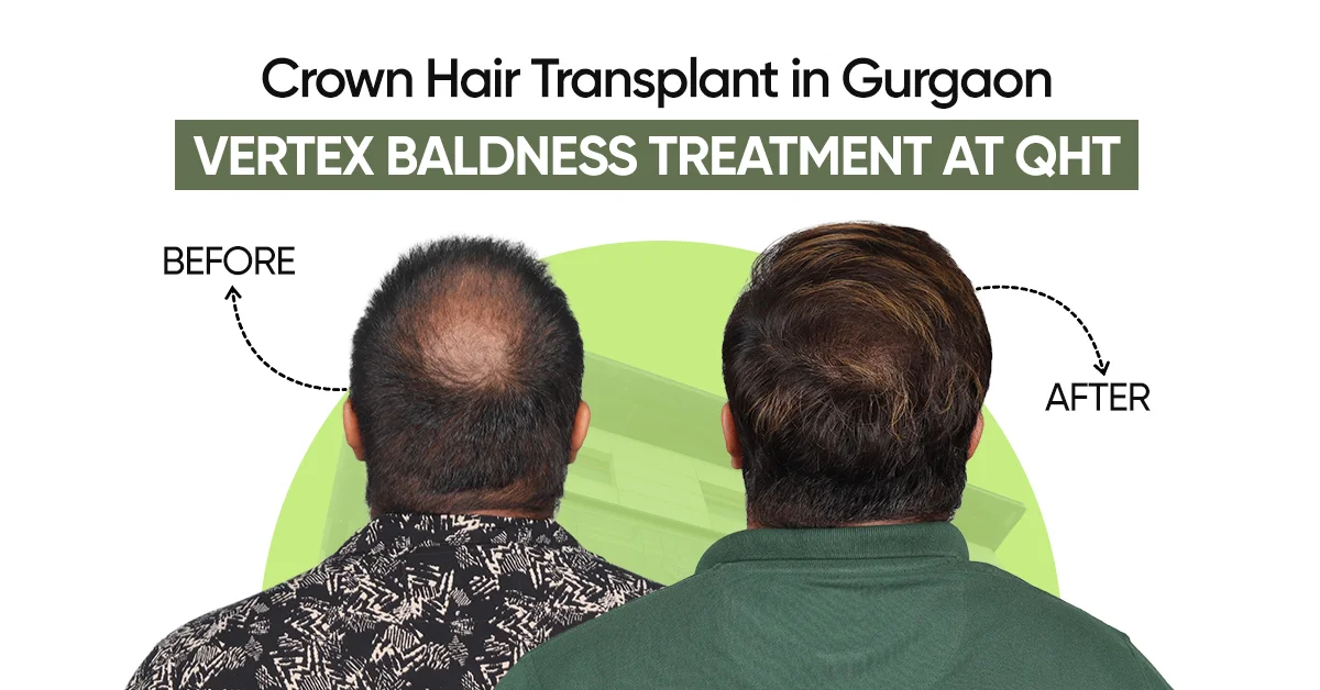 Crown Hair Transplant in Gurgaon