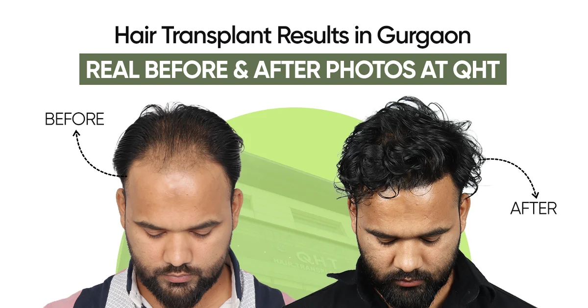 Hair Transplant Results in Gurgaon