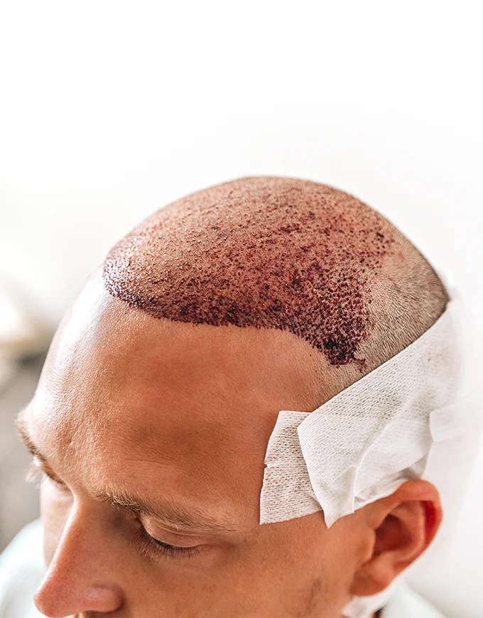 Understanding the Hair Transplant Recovery Timeline in Gurgaon