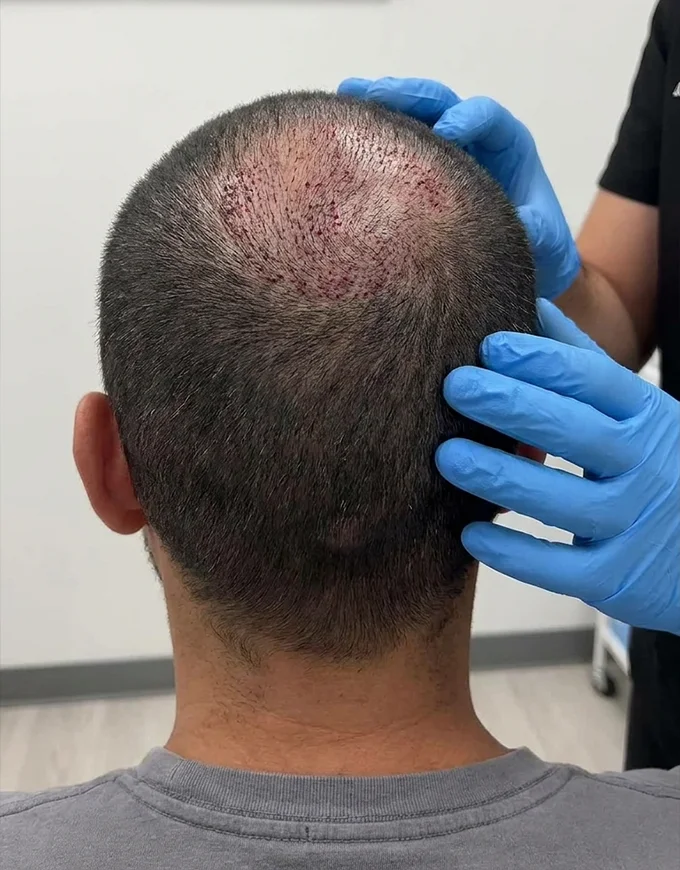 FUE Recovery Timeline and Aftercare to Plan For